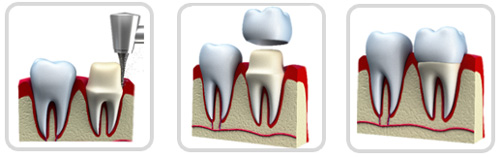 Металлокерамика - зубные протезы
